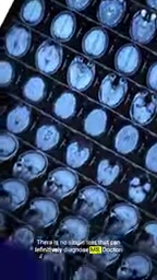 Doctors rely on a combination of MRI, spinal tap, and symptoms for diagnosis