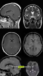 Modern treatments have improved the quality of life for MS patients